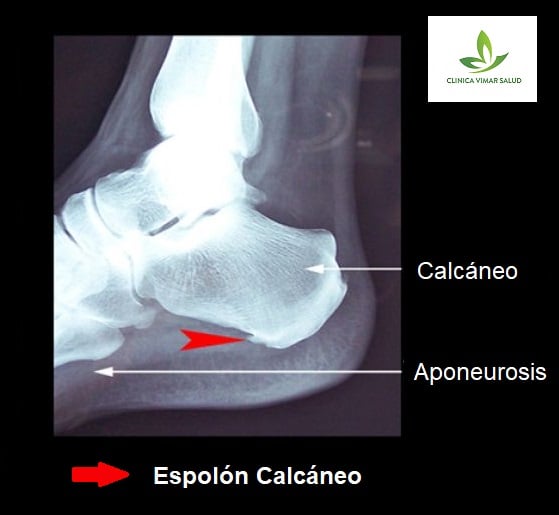 ESPOLON-CALCANEO