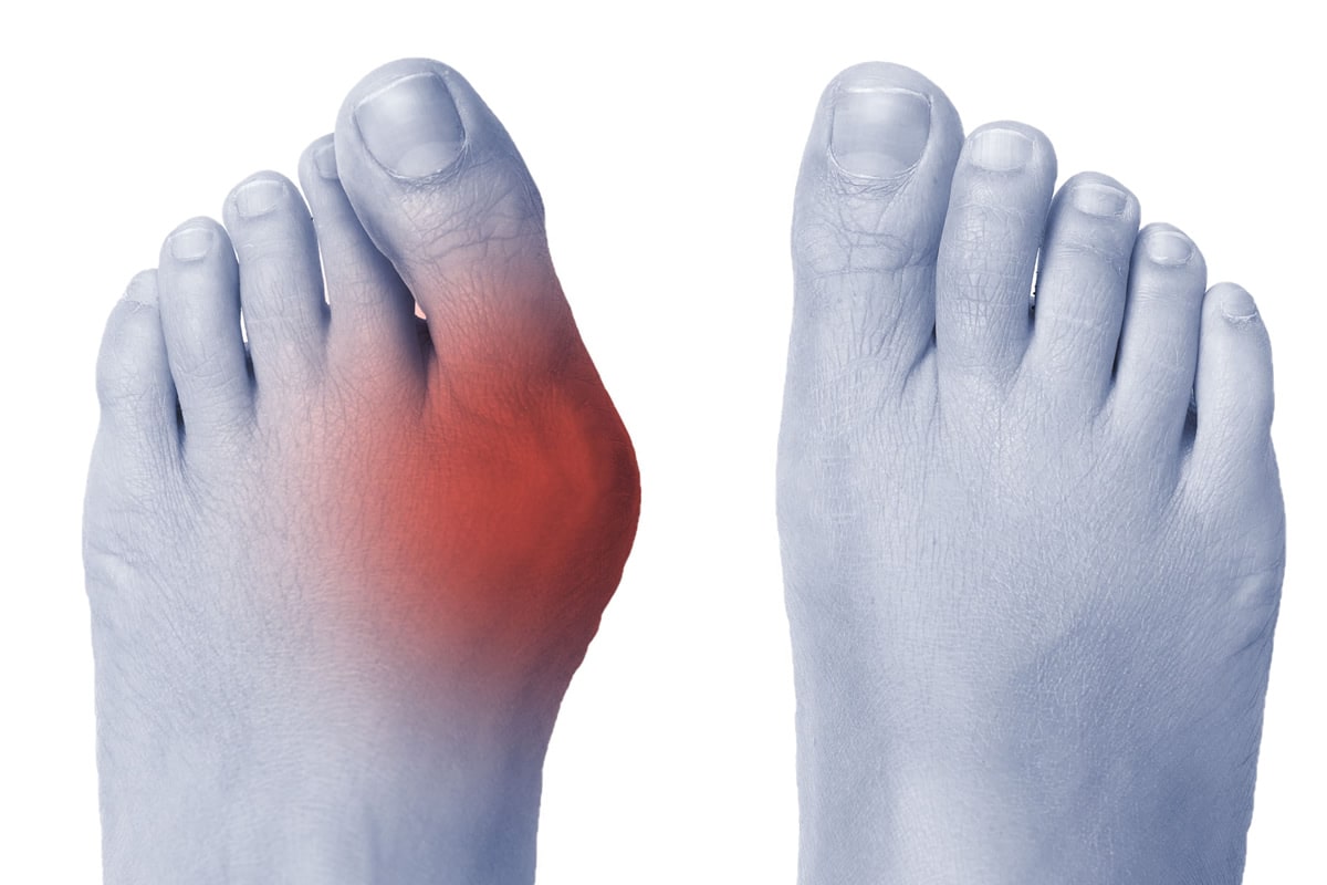 HALLUX VALGUS - JUANETE