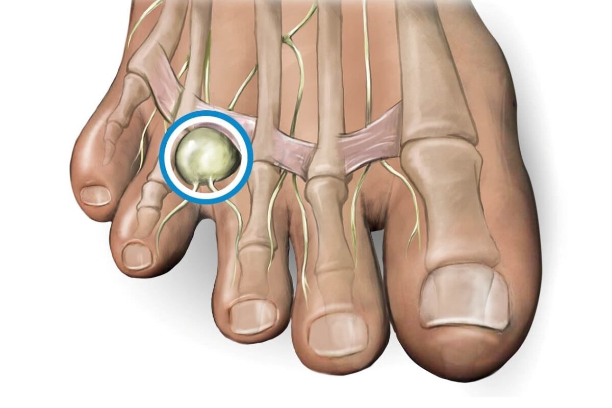 NEUROMA DE MORTON
