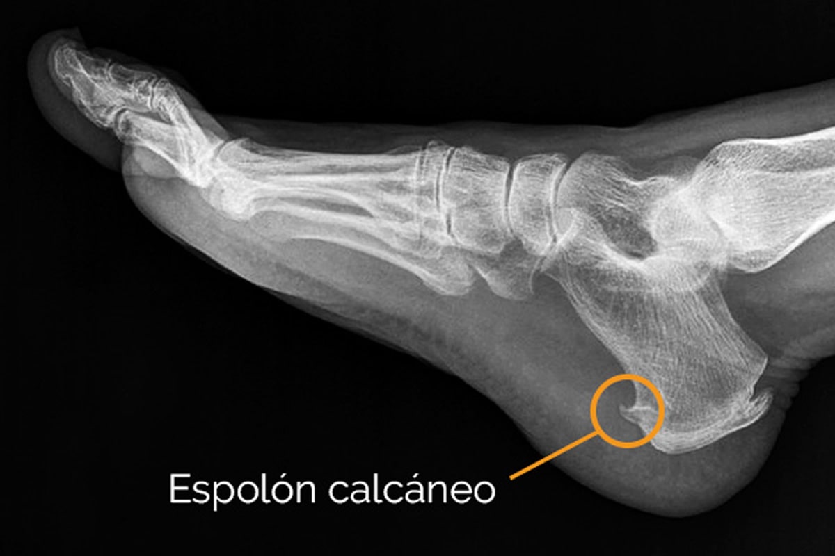 ESPOLÓN CALCÁNEO